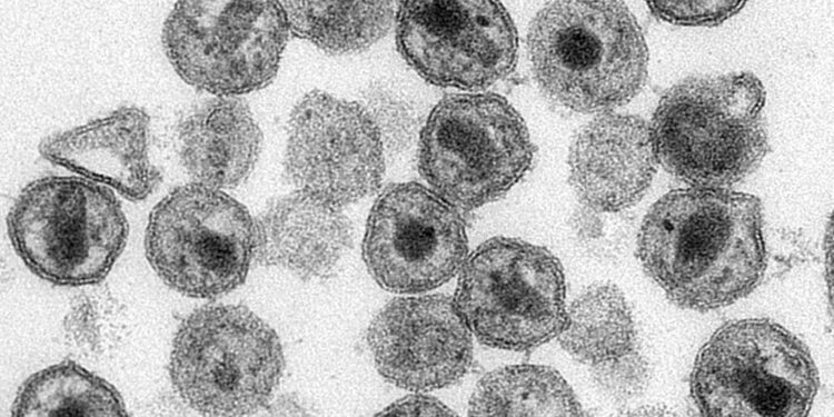 This 2011 electron microscope image made available by the Centers for Disease Control shows HIV virions. On Wednesday, Sept. 11, 2019, scientists are reporting the first use of the gene-editing tool CRISPR to try to cure a patient's HIV infection by providing blood cells that have been altered to resist the AIDS virus. (Maureen Metcalfe, Tom Hodge/CDC via AP)